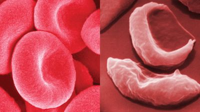 blood cells in sickle cell anemia compared with healthy red blood cells