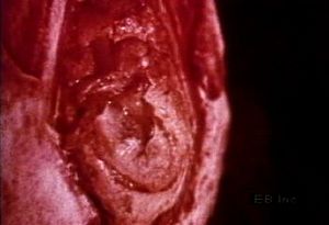 Watch sound wave vibrations in the tympanic membrane