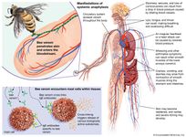 Anaphylaxis
