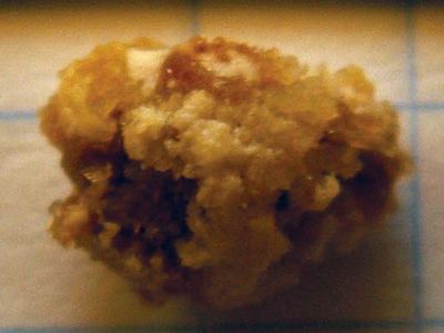 kidney stone