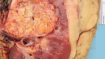 renal cell carcinoma