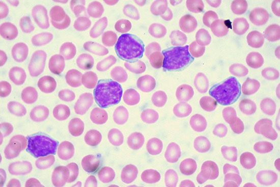 chronic lymphocytic leukemia