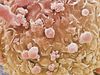 Understand how scientists understand and treat melanoma by targeting the gene B-Raf oncogene