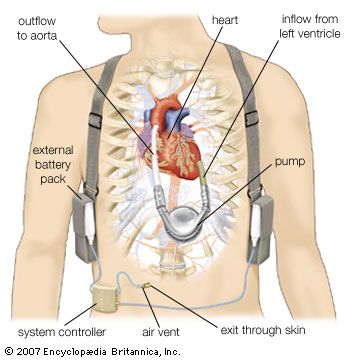ventricular assist device