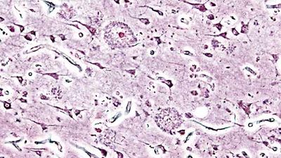 Alzheimer disease